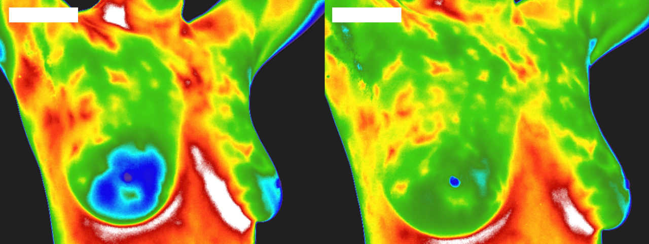 breast thermography before and after cbd treatment